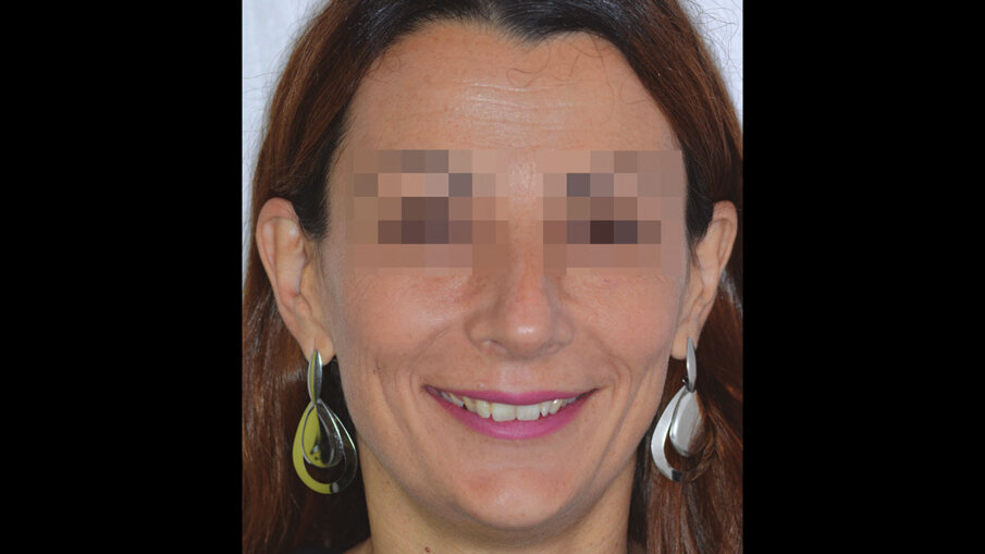 Figg. 4a-4c_Foto extraorali di inizio trattamento.