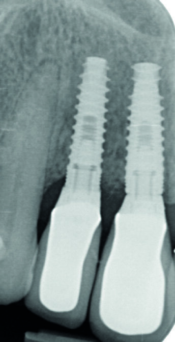 Fig. 18 : Radiographie de contrôle. Notez la parfaite adaptation des différents éléments prothétiques.
Notez aussi la très bonne cicatrisation osseuse péri-implantaire surtout en 12 (comparaison possible avec la figure 7).
