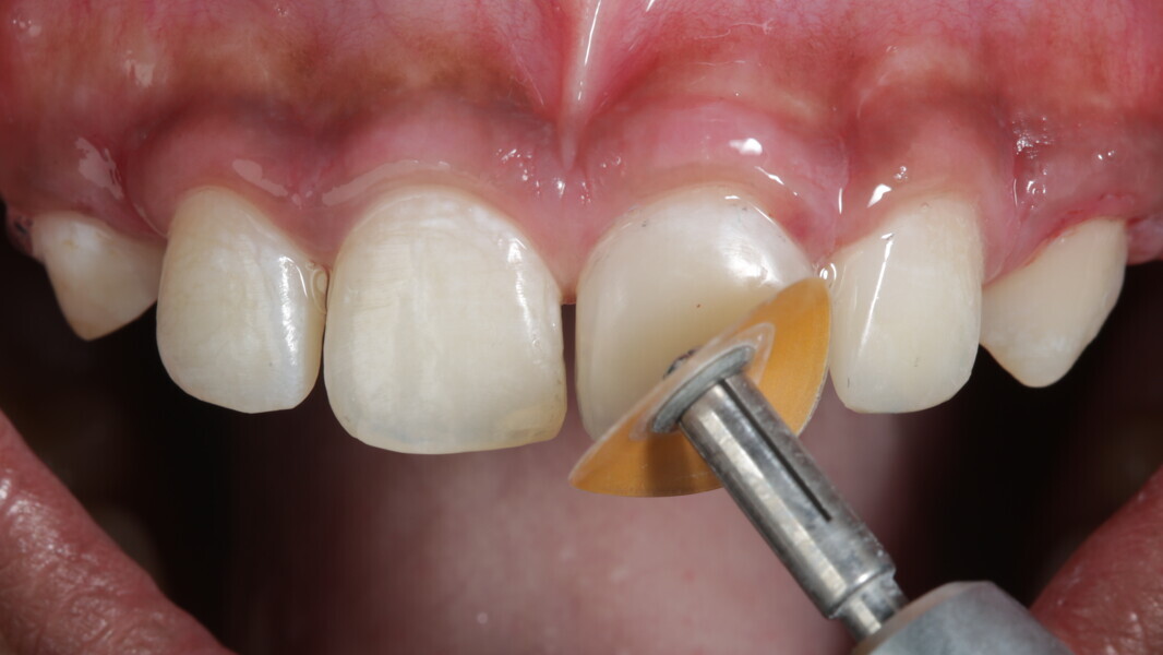 Fig 34: Sof-Lex finishing fine disc was used to smoothen the surface at high speed with irrigation.