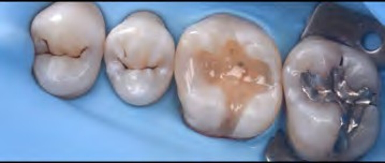  Fig. 2f: Further anatomical characterization of the occlusal surface using finishing burs. 