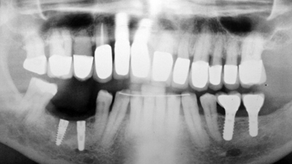 Impression of steeply angulated implants: A new method