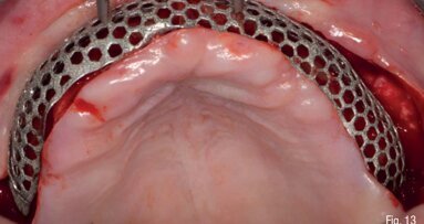 Riabilitazione di un mascellare gravemente atrofico mediante approccio digitale