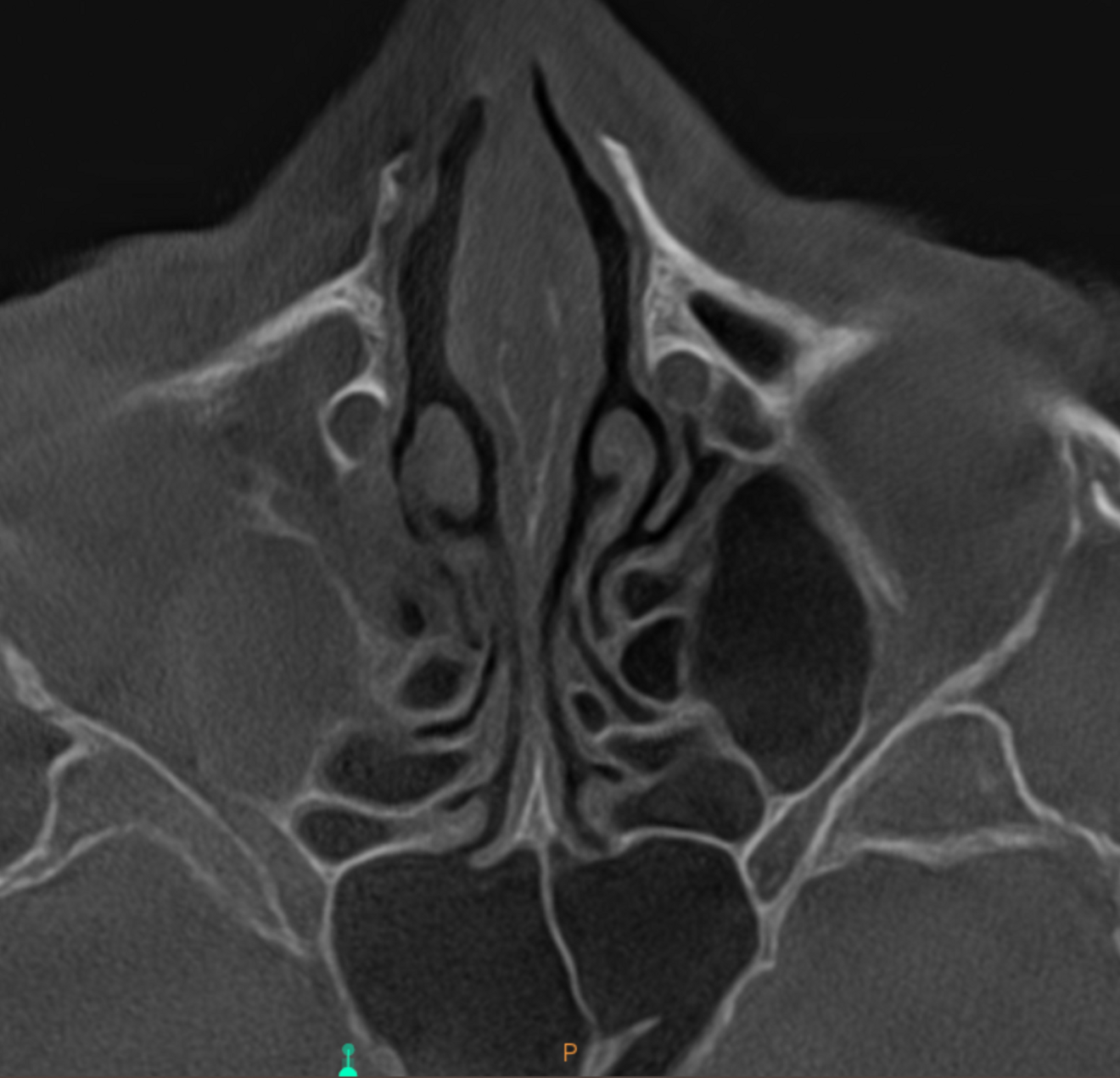 Fig. 5e: High-level transversal cross-section of the maxilla showing involvement of the sphenoid and ethmoid sinuses.