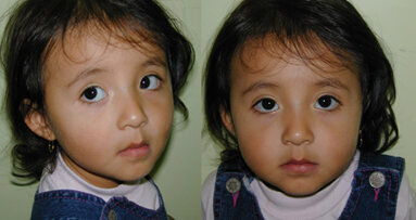 La protracción maxilar precoz sin expansión