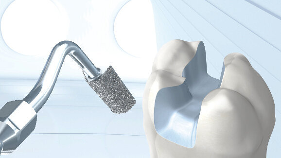 All-ceramic restorations: Webinar addresses key issues