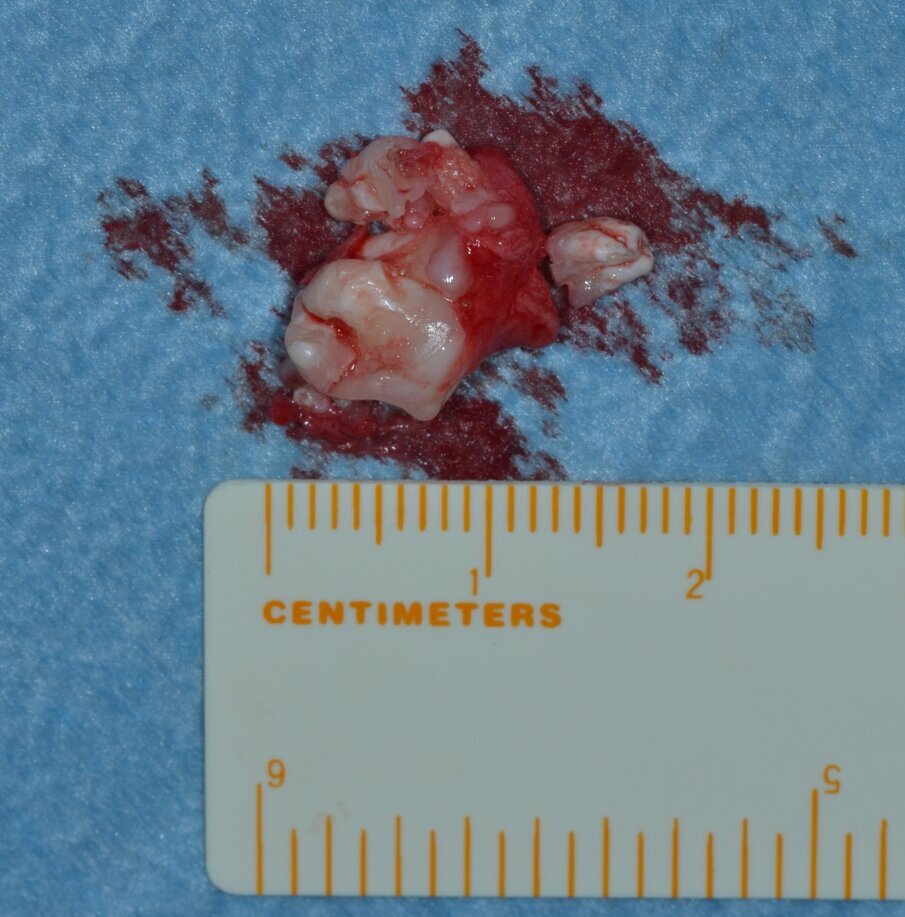 Fig. 11_Misurazione ex vivo del pezzo operatorio.