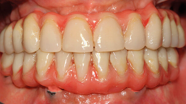 Procedura implanto-protesica a carico immediato: il successo è il sorriso del paziente