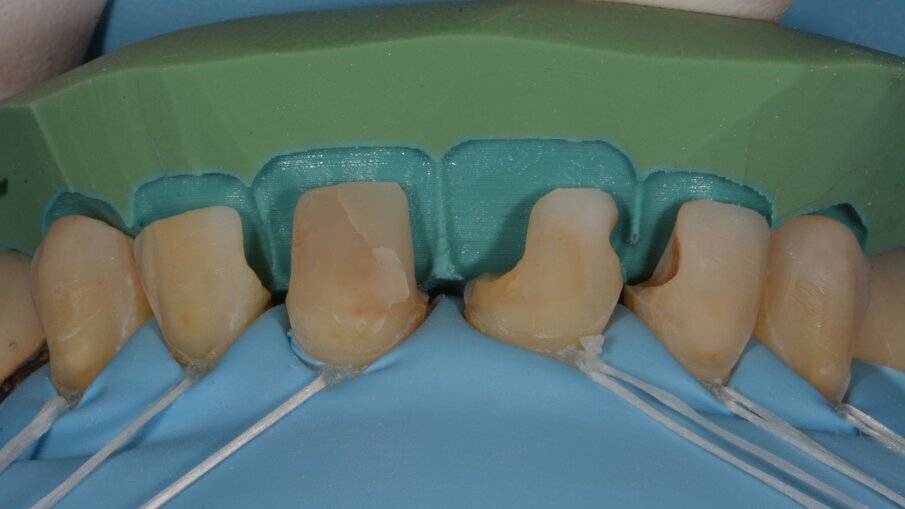Aan de hand van het digitale model werd een palatale putty gemaakt, die dienst deed als basis van onze nieuwe opbouw.