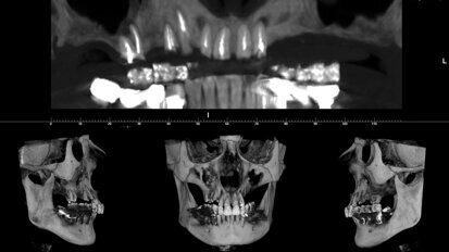 Conservazione del processo alveolare con sostituto osseo di origine equina a lento riassorbimento