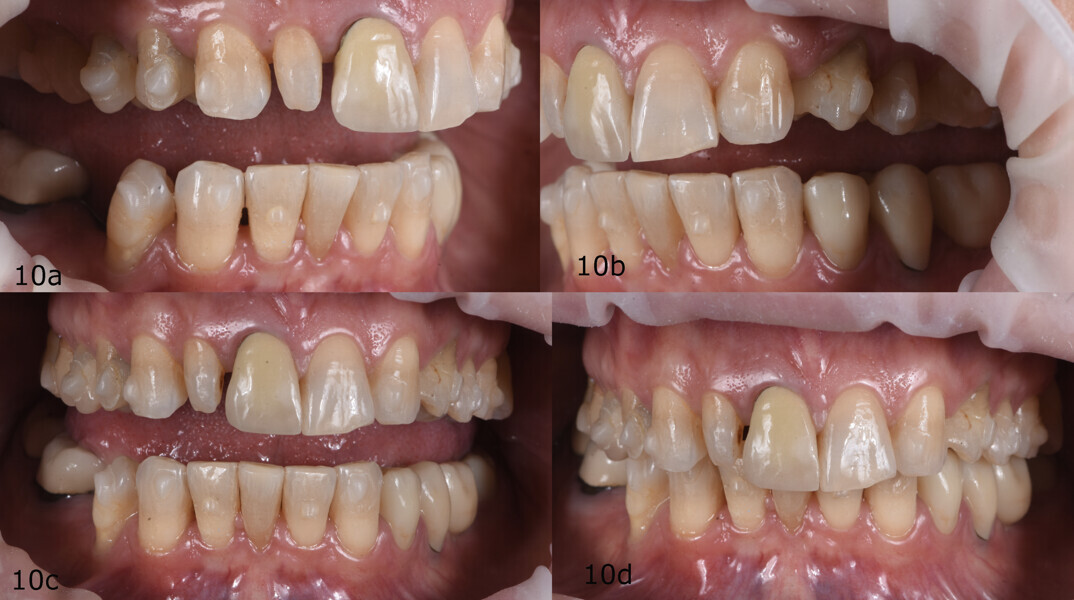 Figs. 10a–d: Intra-oral photographs after alignment.