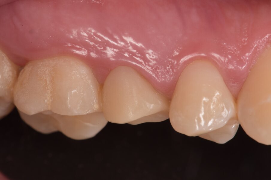 Fig. 4_Posizionamento di un provvisorio in Telio realizzato secondo tecnica chairside. 