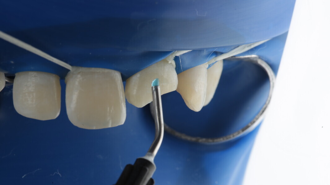 Fig 11: Selective etching with 37% Phosphoric acid was used to etch the enamel for 20 seconds.