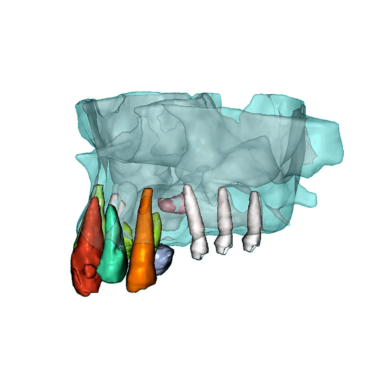 Fig. 6a: Use of selective transparency in the planning software to visualise the relationship between the crowns, roots and surrounding anatomical structures. Left lateral view.