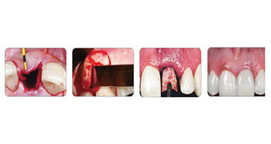 Νέα Τεχνική IDR -Άμεσης Οδοντοφατνιακής Αποκατάστασης σύμφωνα με τον Dr.J.C.M. Rosa