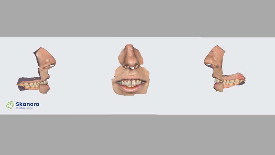 Slika 2a Izgled face scan-a, kod drugog pacijenta. (dr Dejan Stajčić)