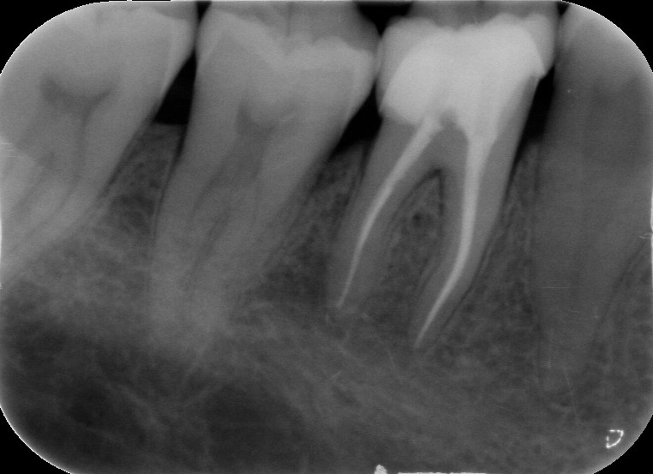 Fig. 24 : Radiographie de suivi après cinq ans.