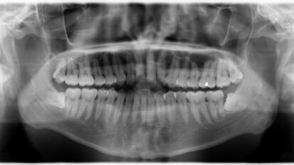 Ακτινογραφίες και καρκίνος του θυρεοειδή