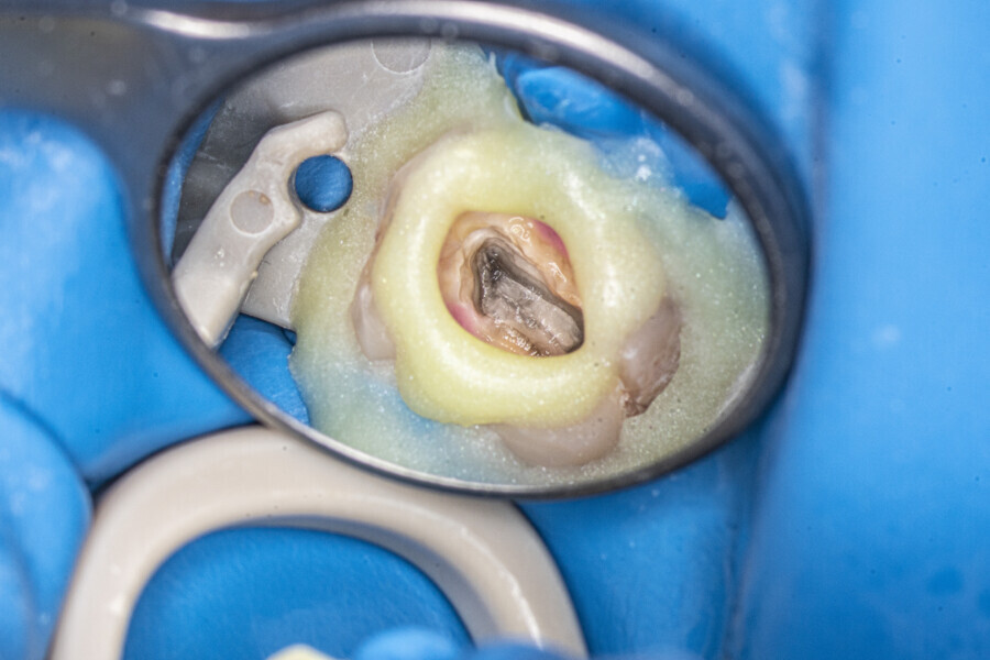 Fig. 54: Buccal side of the pulp chamber once the calcification had been partially removed. No orifices could be seen yet.