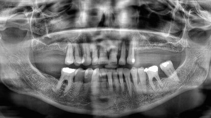 Immediate loading of the posterior maxilla with two abutment-level bridges produced in a digital workflow