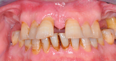 Riabilitazione a carico immediato  con impianti a connessione  conometrica: report di un caso  con due anni di follow-up