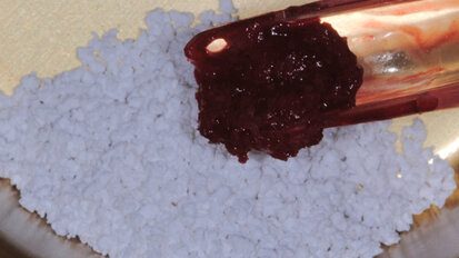 Sinus lift con innesto di NanoBone®: risultati clinici ed evidenze istologiche a 13 mesi di guarigione