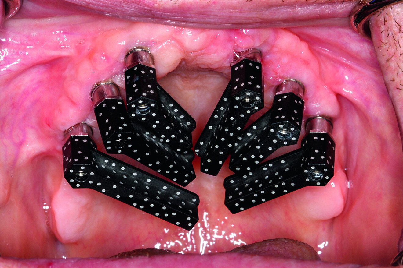 Fig. 4 : Un seul dispositif peut désormais capturer l’ensemble d’une arcade de piliers de scan codés ainsi que la topographie des tissus mous grâce à la photogrammétrie intra-orale.