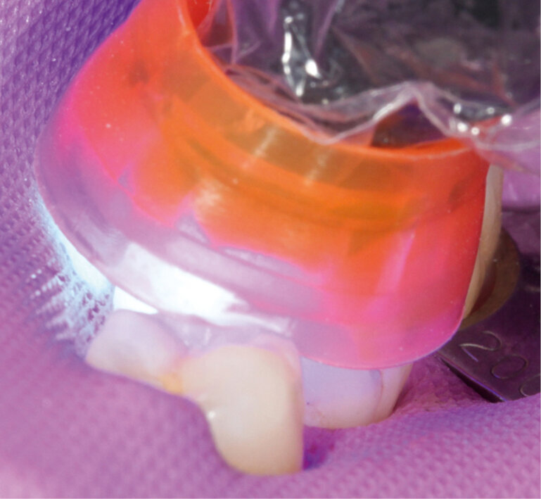 Fig. 10: Light-curing for 10 s using Bluephase Style