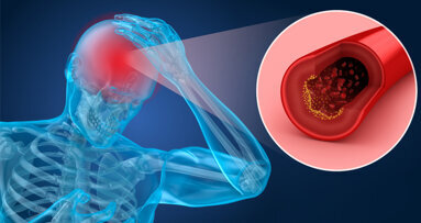 Warum gute Zahnpflege vor einem Schlaganfall schützen kann