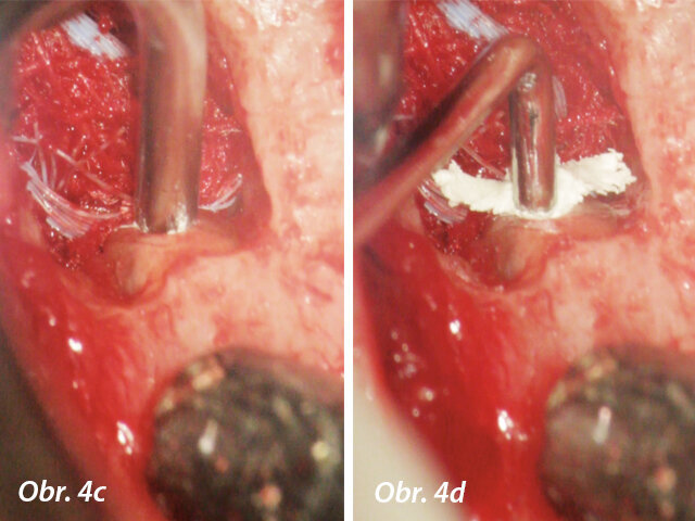 Aplikace PD MAP White pomocí MAP systému a kondenzace MTA pluggerem