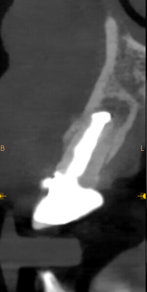 Fig. 3: Initial CBCT scan. Coronal view of tooth #21 showing buccal bone loss.
