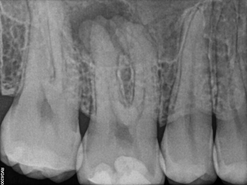 Fig. 37: Pre-op radiograph of the maxillary first molar.