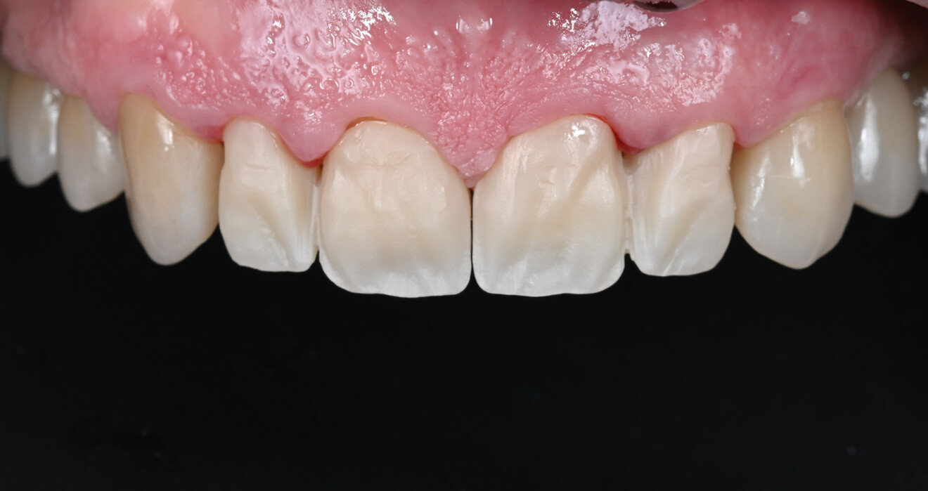 Fig. 4 : Essayage des restaurations.