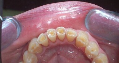 Relazione tra erosione dentale e reflusso gastro-esofageo