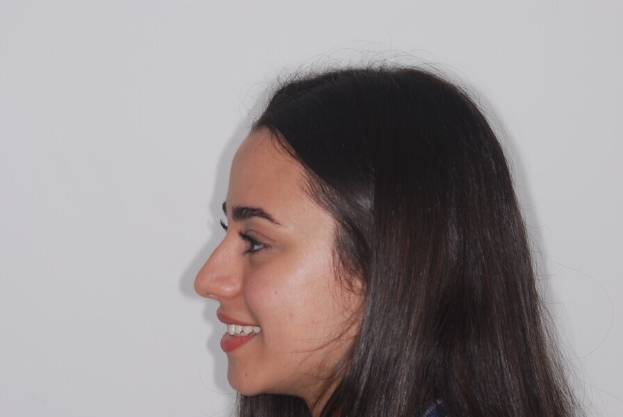 Fig. 4: Profile after treatment.