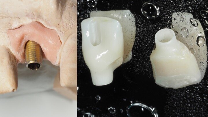 Figura 20. Pilar Duomo y corona de zirconio con cerámica feldespática. 