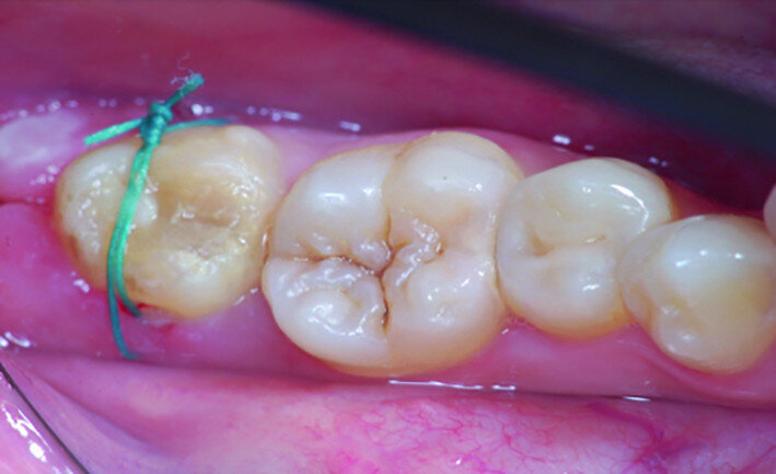 Fig. 17c: Clinical images: Two weeks after surgery, before suture removal.