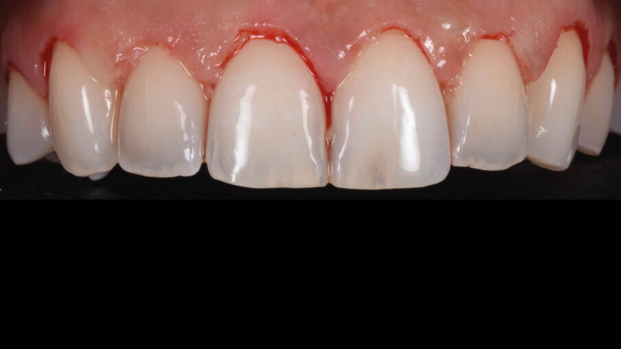 Fig. 12_Esposizione dello smalto dopo la gengivectomia.