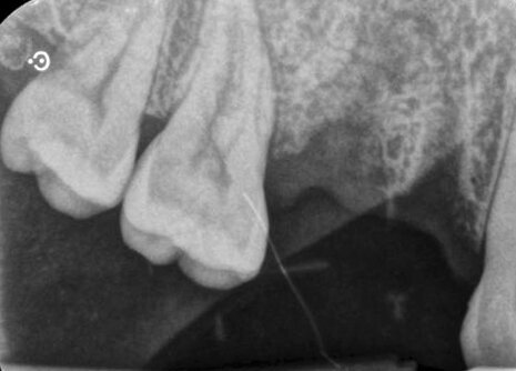 Fig. 1_Radiografia periapicale a 8 settimane dall’estrazione di 14 e 15.