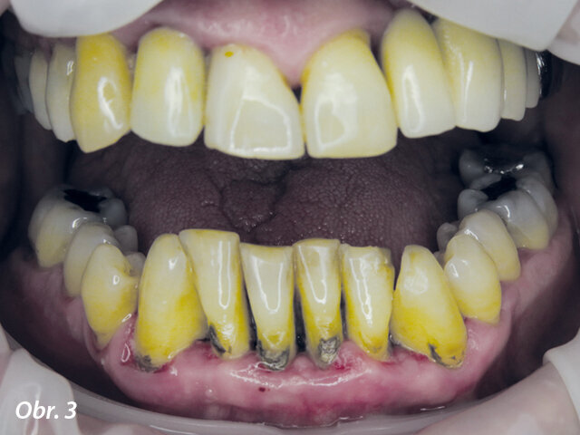 Obr. 3–5: Intraorální nález při vstupním vyšetření