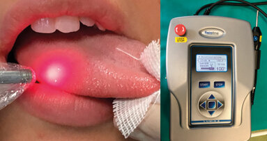 Burning Mouth Syndrome. La gestione del dolore mediante la Low Level Laser Therapy