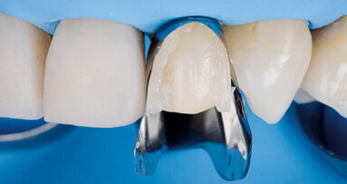 Přímé vrstvení kompozitních fazet