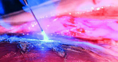 Il laser in odontoiatria un mercato in costante crescita