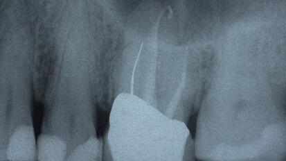 The utility of cone-beam computed tomography in endo