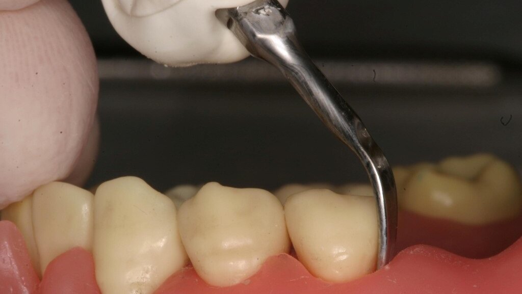 Στρατηγικές για εργονομική χρήση των εργαλείων ριζικής απόξεσης