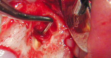Apical microsurgery: REF materials, techniques (Part 5)