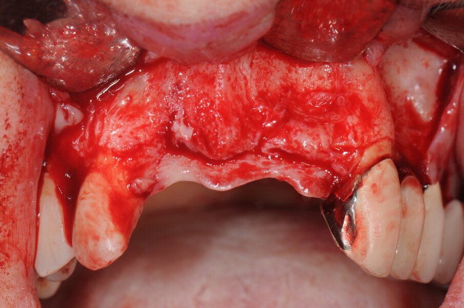 Figg. 8a, 8b - Esposizione del sito chirurgico e valutazione dei volumi ossei.