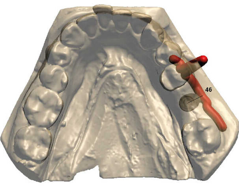Fig. 6 : Détermination des limites périphériques du guide.