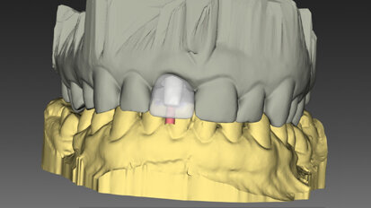 Využití současných technologií a digitálních řešení v okamžité jednodobé implantaci