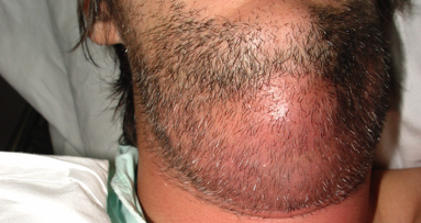 Manejo y prevención de infecciones odontogénicas