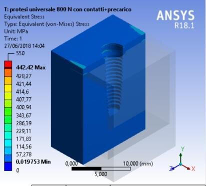 Fig. 11a - Von Mises results, universal prosthesis.